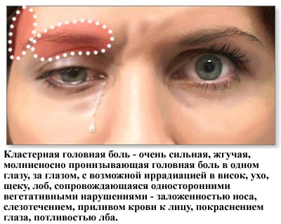 Фото кластерной головной боли