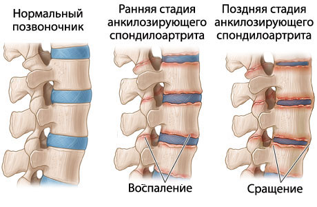 Болезнь Бехтерева. Aksimed.ua. Как выглядит болезнь Бехтерева